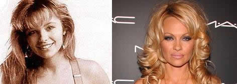 Ciruga famosa: Pamela Anderson y ciruga esttica