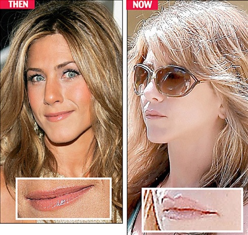 cirugía estética y Jennifer Aniston