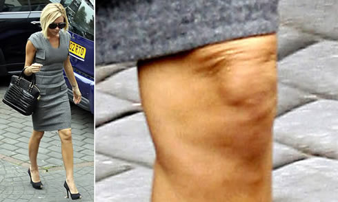 Celulitis famosas: Victoria Beckham con celulitis