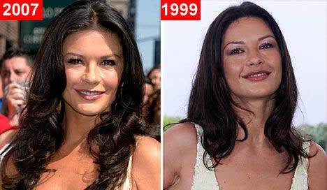 Catherine Zeta-Jones Cirugía Estética